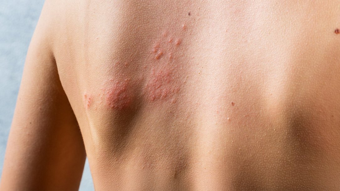 Impfung gegen Gürtelrose (Herpes zoster) Impfung gegen Gürtelrose (Herpes zoster)