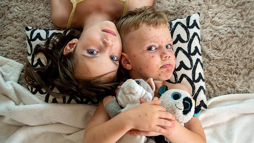 Impfung gegen Windpocken Impfung gegen Windpocken