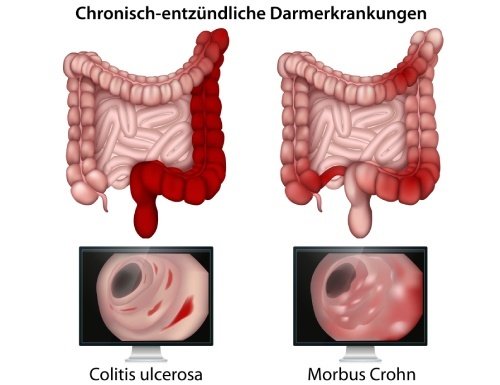 Unterschied Colitis Ulcerosa und Morbus Chron