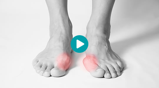 Was ist ein Hallux valgus und wie wird er behandelt?